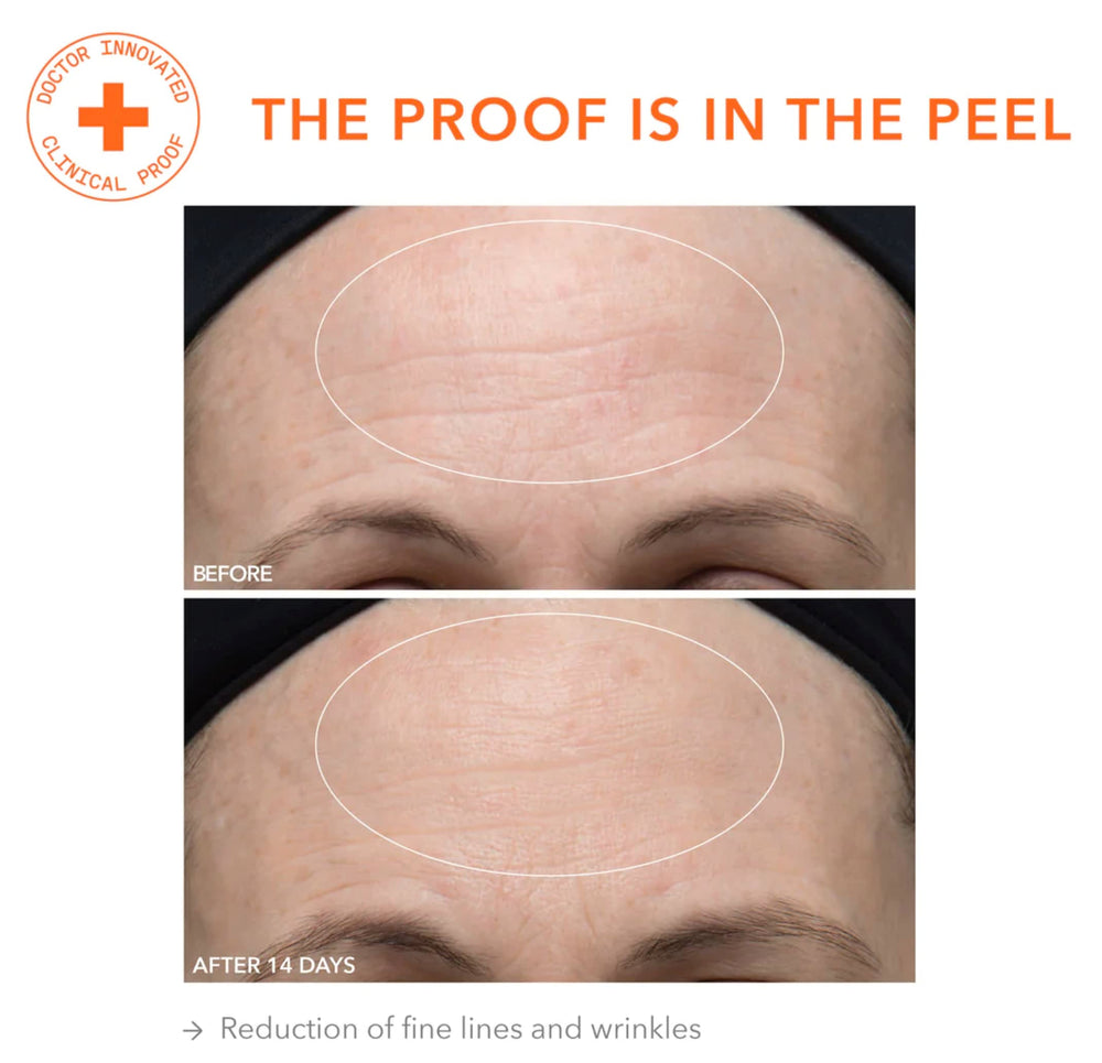 Dr Dennis Gross closeup of pores after treatment demonstrates refinement.