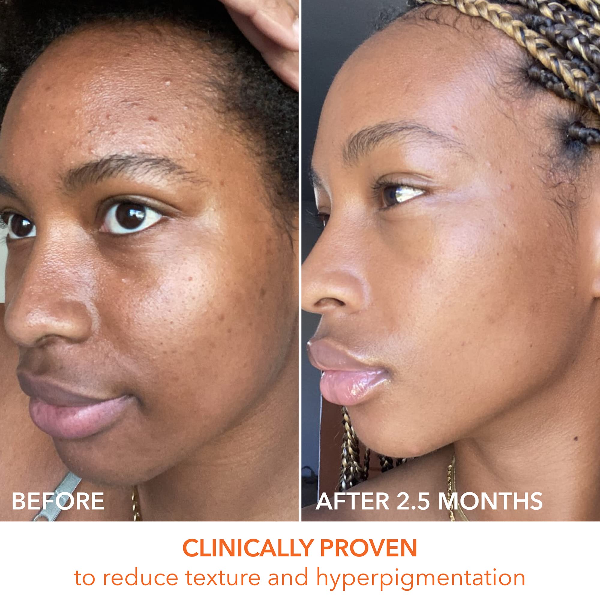 Dr Dennis Gross Alpha Beta Universal Daily Peel glow after use signals refreshed uneven tone improvement.