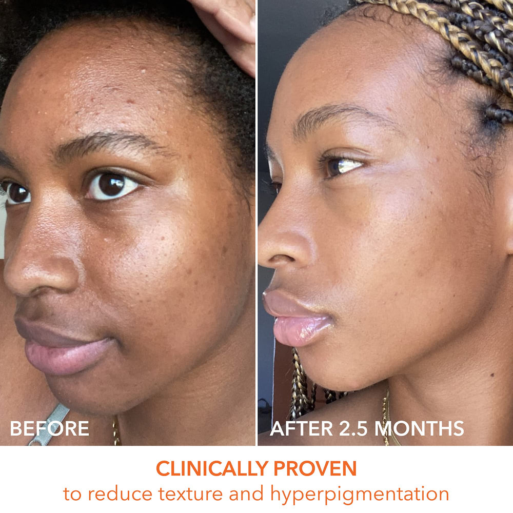 Dr Dennis Gross Alpha Beta Universal Daily Peel glow after use signals refreshed uneven tone improvement.