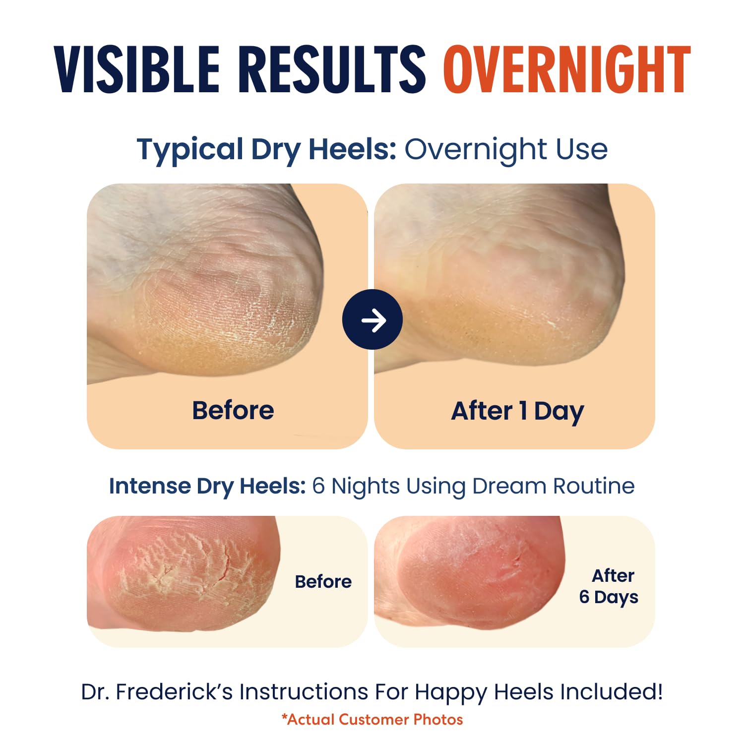 Dr. Frederick's Original breathable toeless heel socks highlight comfortable fit.