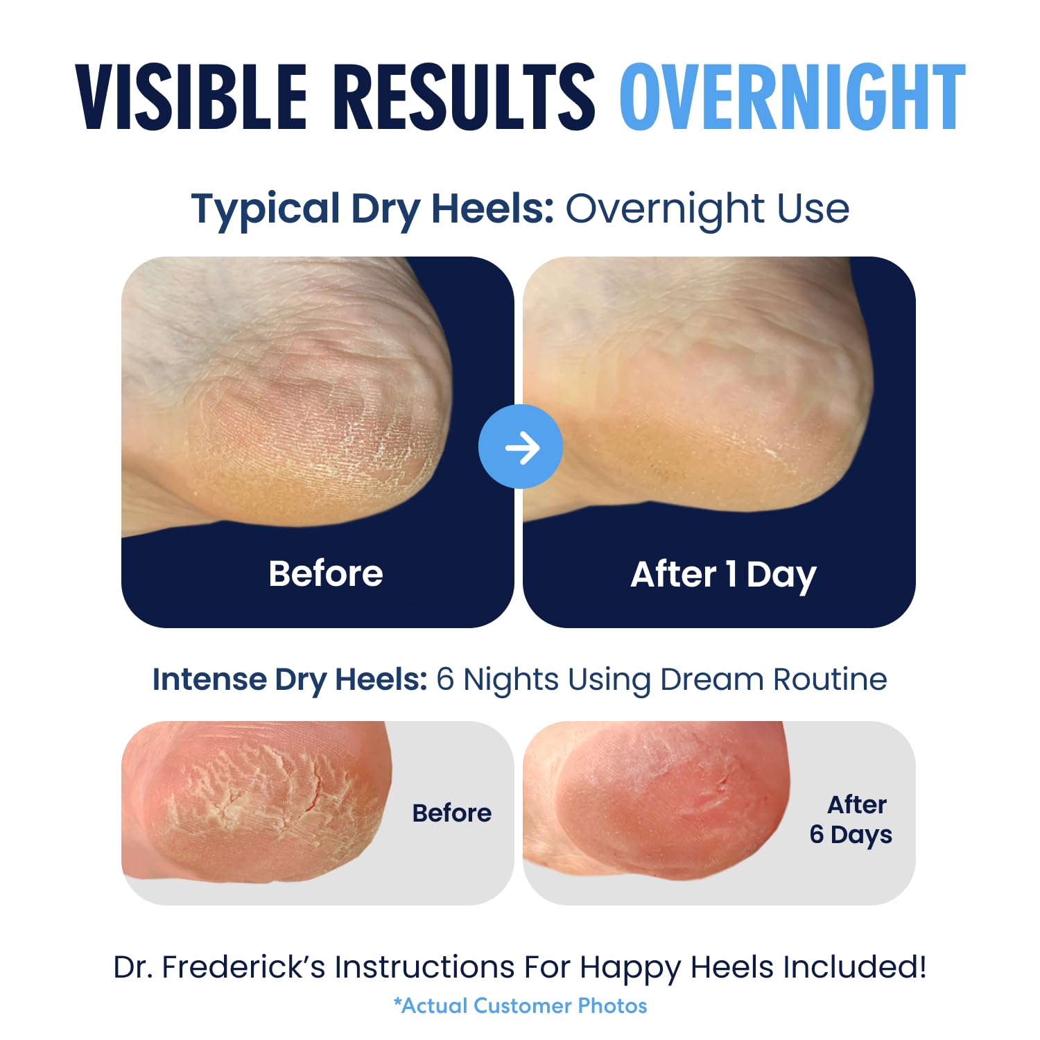 Nighttime use with Dr. Frederick's Original socks for gentle care.