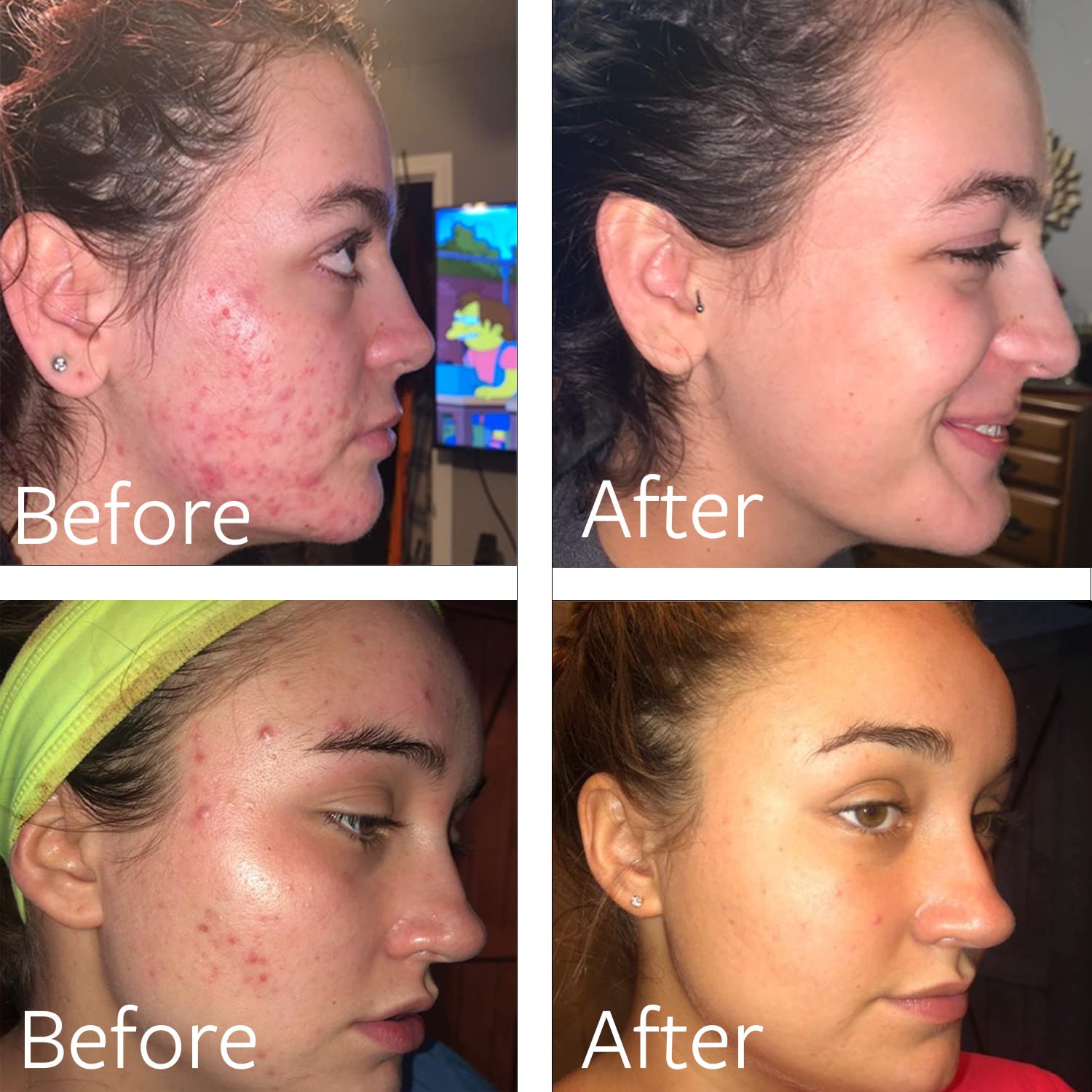 Dr Song benzoyl peroxide wash closeup texture highlights micro-benzoyl peroxide action