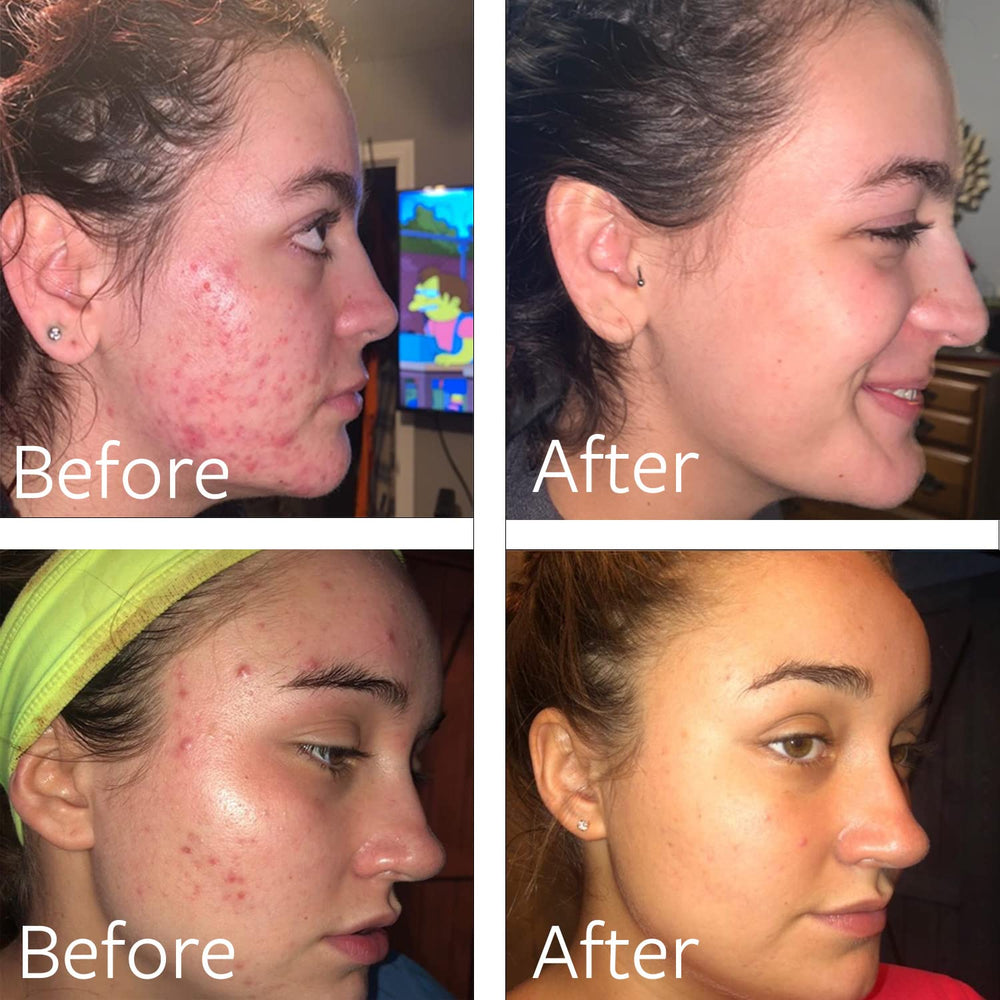 Dr Song benzoyl peroxide wash closeup texture highlights micro-benzoyl peroxide action