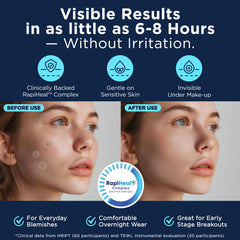Dura Cleanse Pimple Patches large size for stubborn pimples.