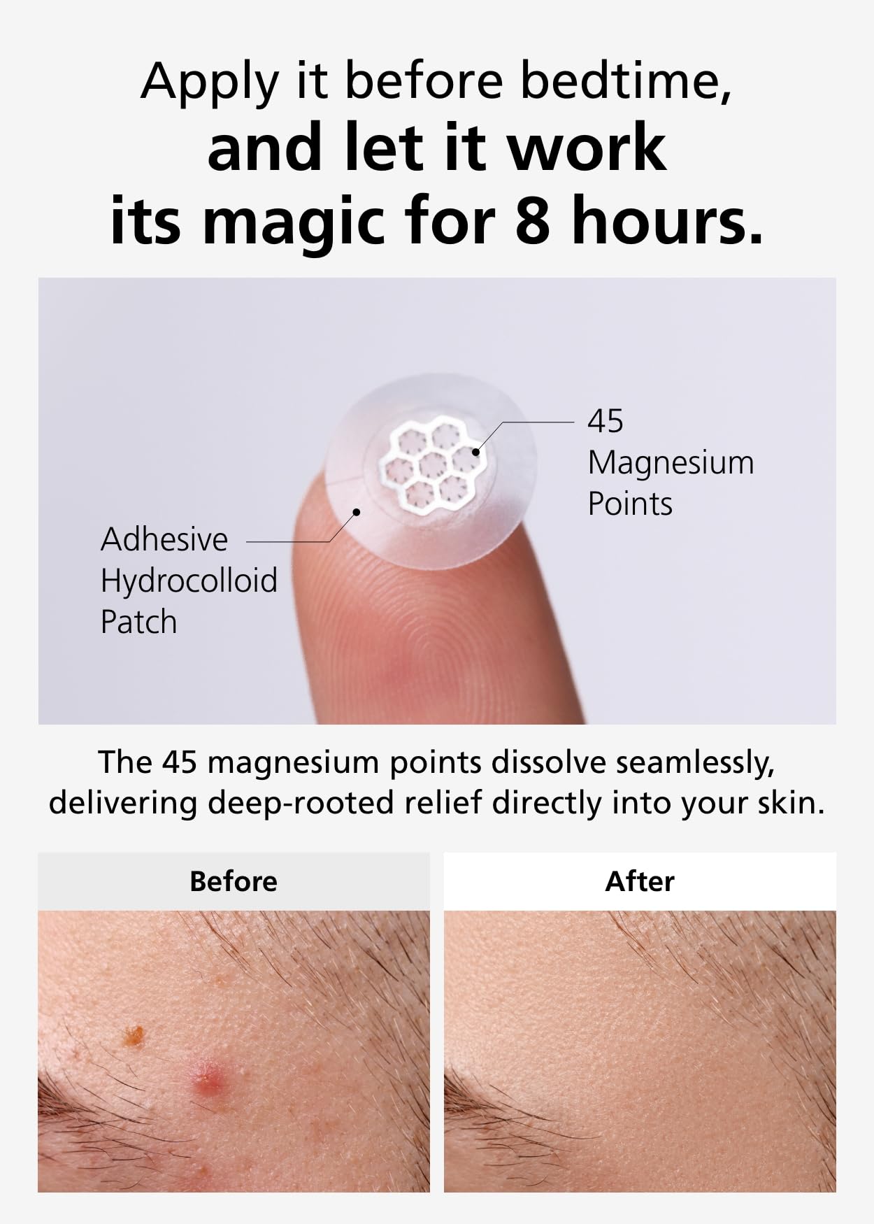 DWEasyDerm Hydrocolloid band adheres securely on uneven skin.