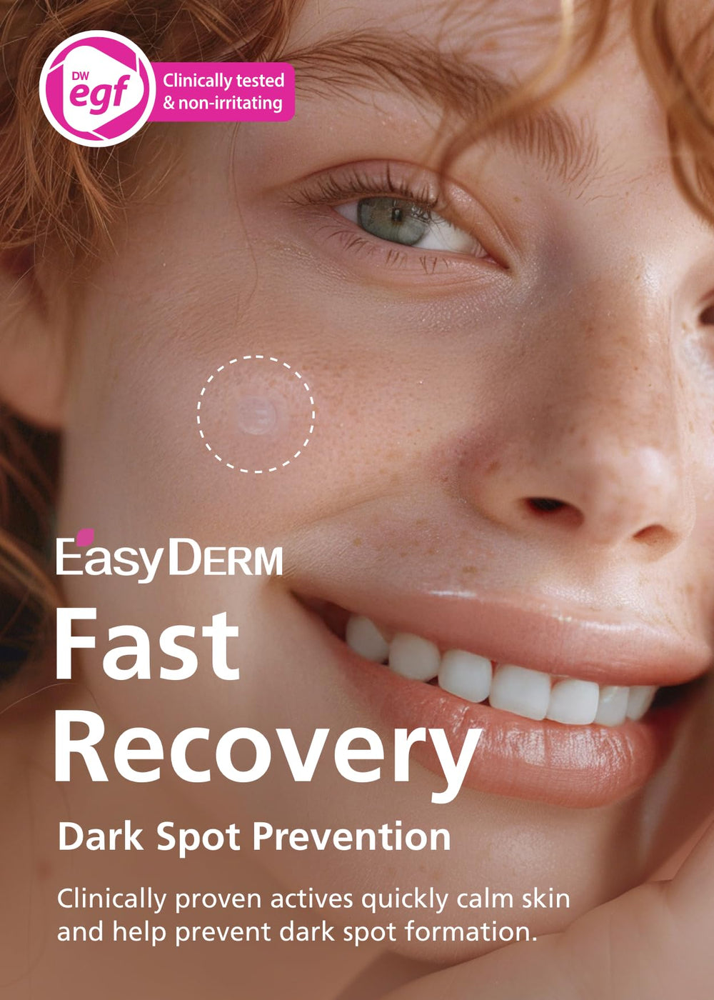 DWEasyDerm microdart patch technology demonstrates precision delivery to deep blemishes.