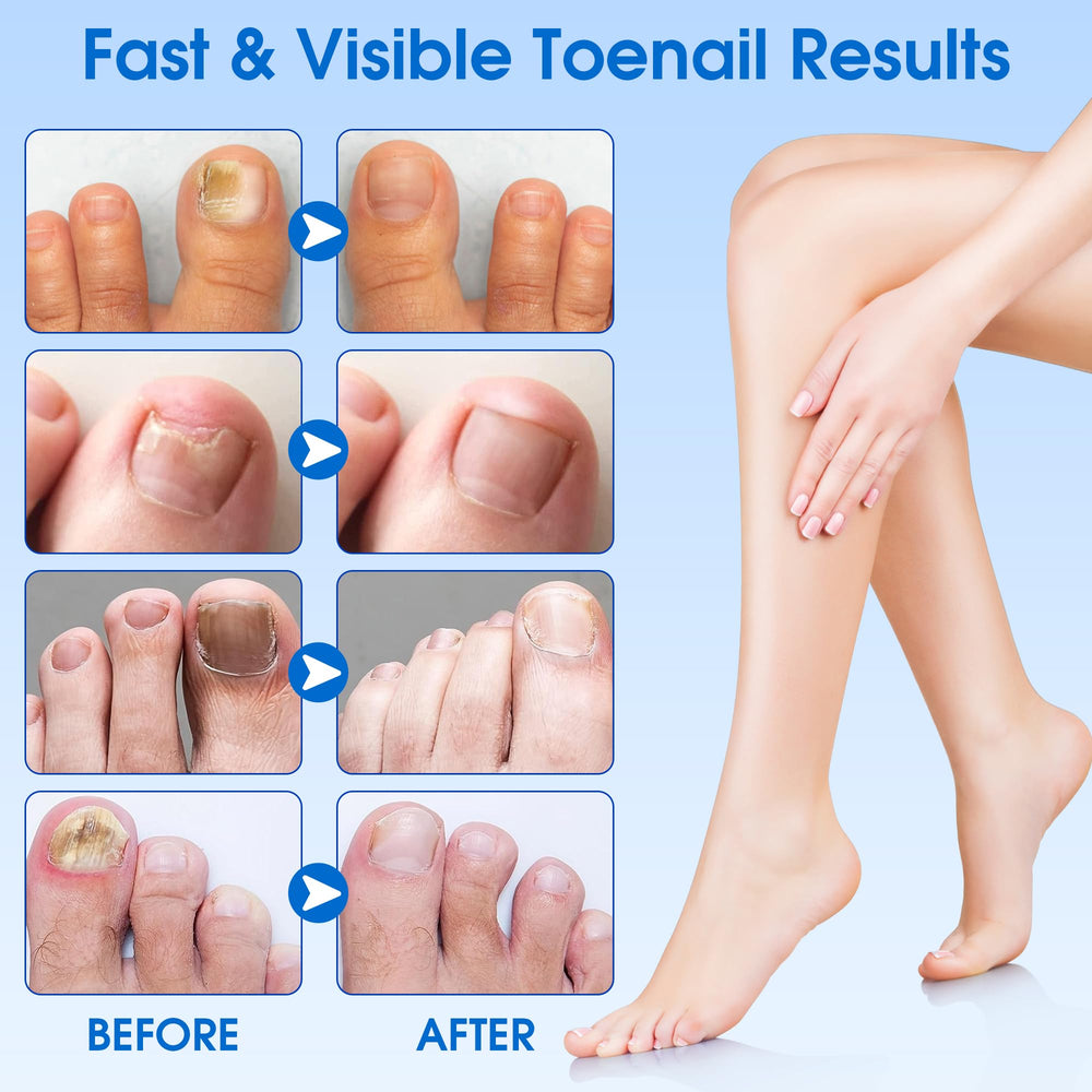 EASICUTI patch affixed to toenail during nighttime routine.