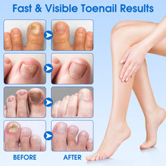 EASICUTI patch affixed to toenail during nighttime routine.
