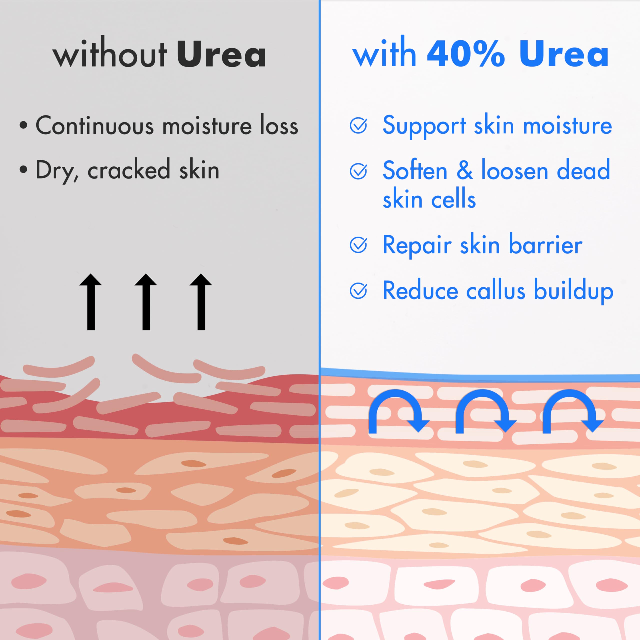Ebanel Urea Cream 40% on cracked heel for moisture and softness.