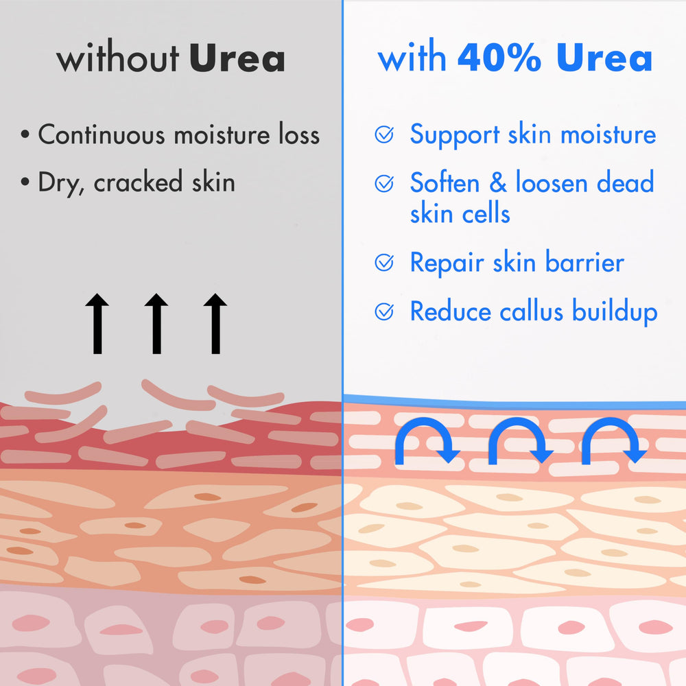 Ebanel Urea Cream 40% on cracked heel for moisture and softness.