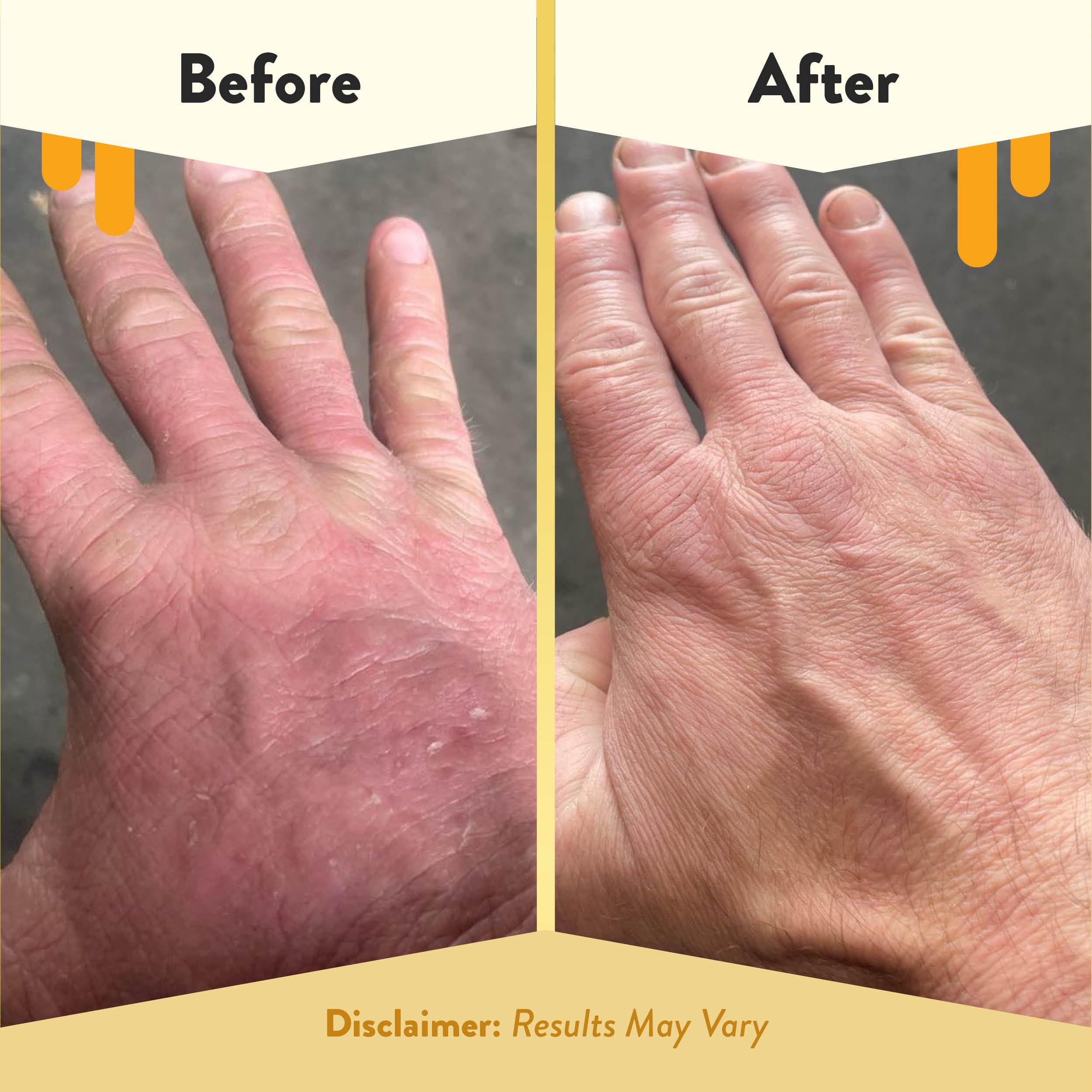 Eczema Honey hand soap with coconut oil nourishes while cleansing hands