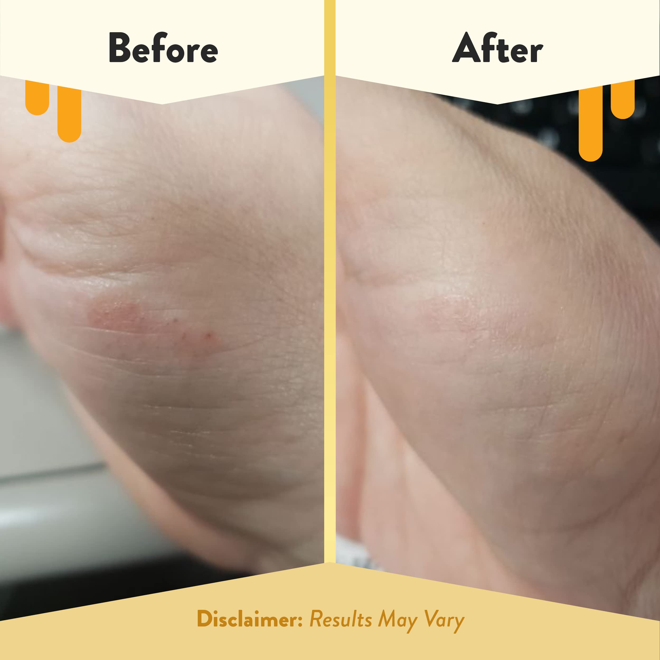 Discos Eczema Honey con aloe y jojoba para hidratación suave.
