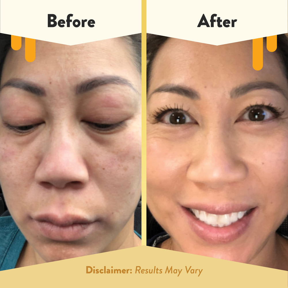 ECZEMA HONEY lip care application showing soft, moisturized lips during flare-ups