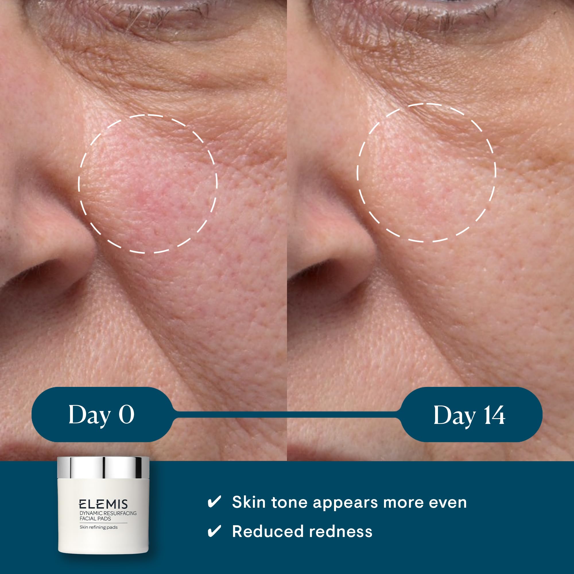 ELEMIS Dynamic Resurfacing Pads textured-side usage reveals exfoliation for refined texture