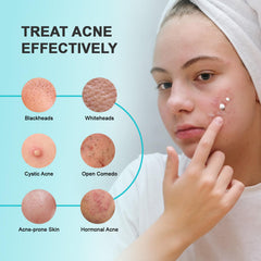 Enaskin Naturals 2% salicylic acid spot cream targeting cystic breakouts.