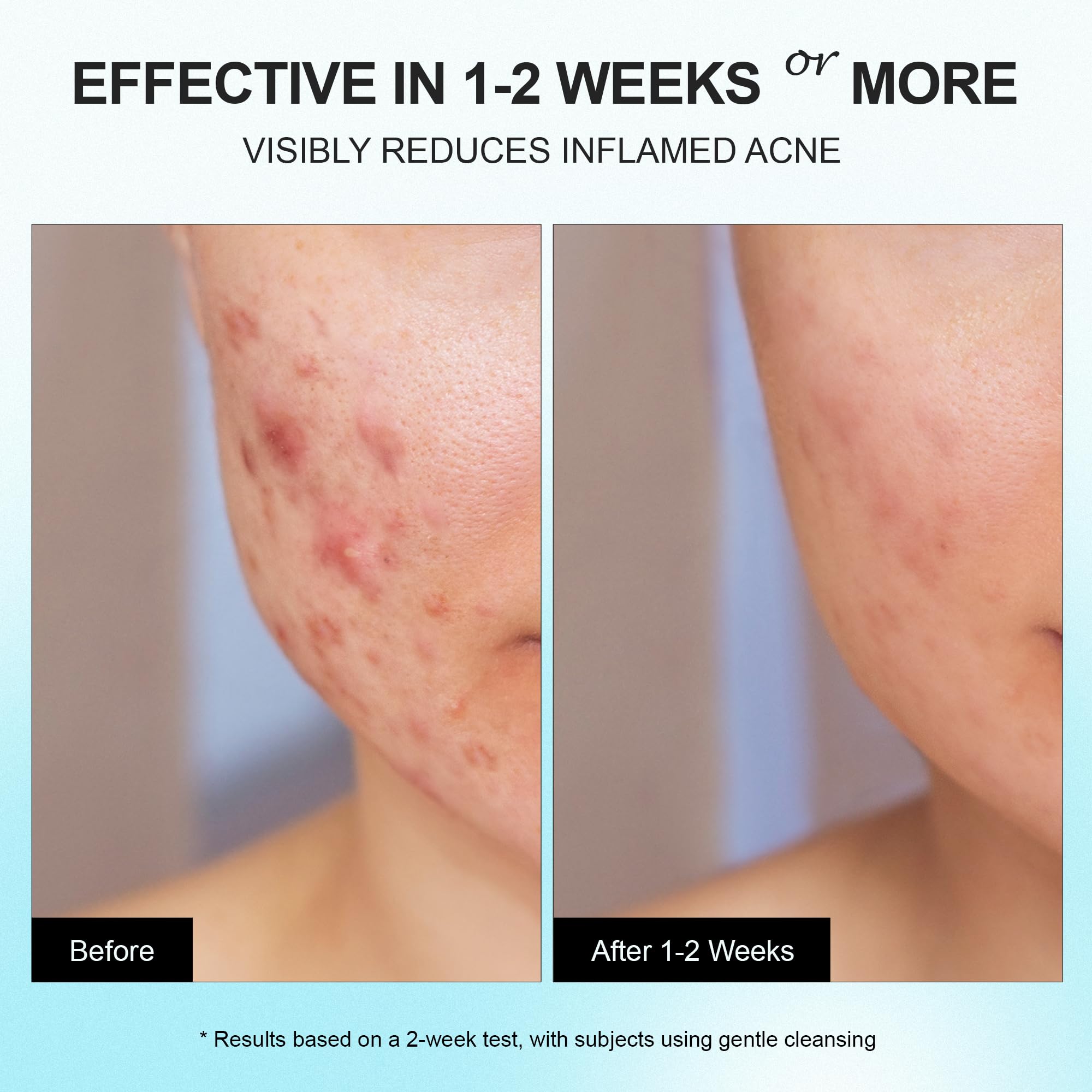 Enaskin Naturals face and back acne treatment applied across multiple zones.