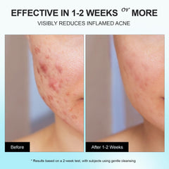 Enaskin Naturals face and back acne treatment applied across multiple zones.