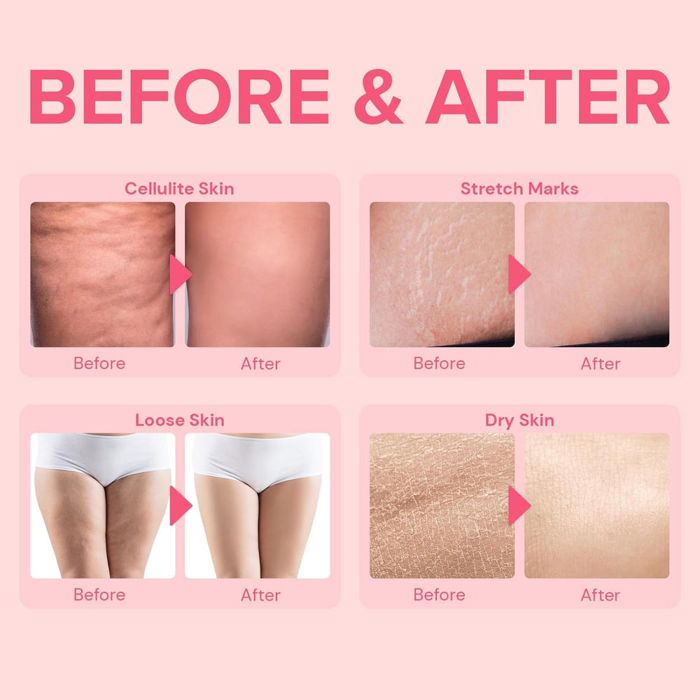Enaskin Naturals tightening lotion for stomach and midsection tightens loose skin.