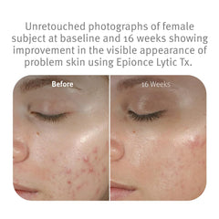 Epionce Lytic Tx pore-closeup demonstrates cleaner pores and smoother appearance