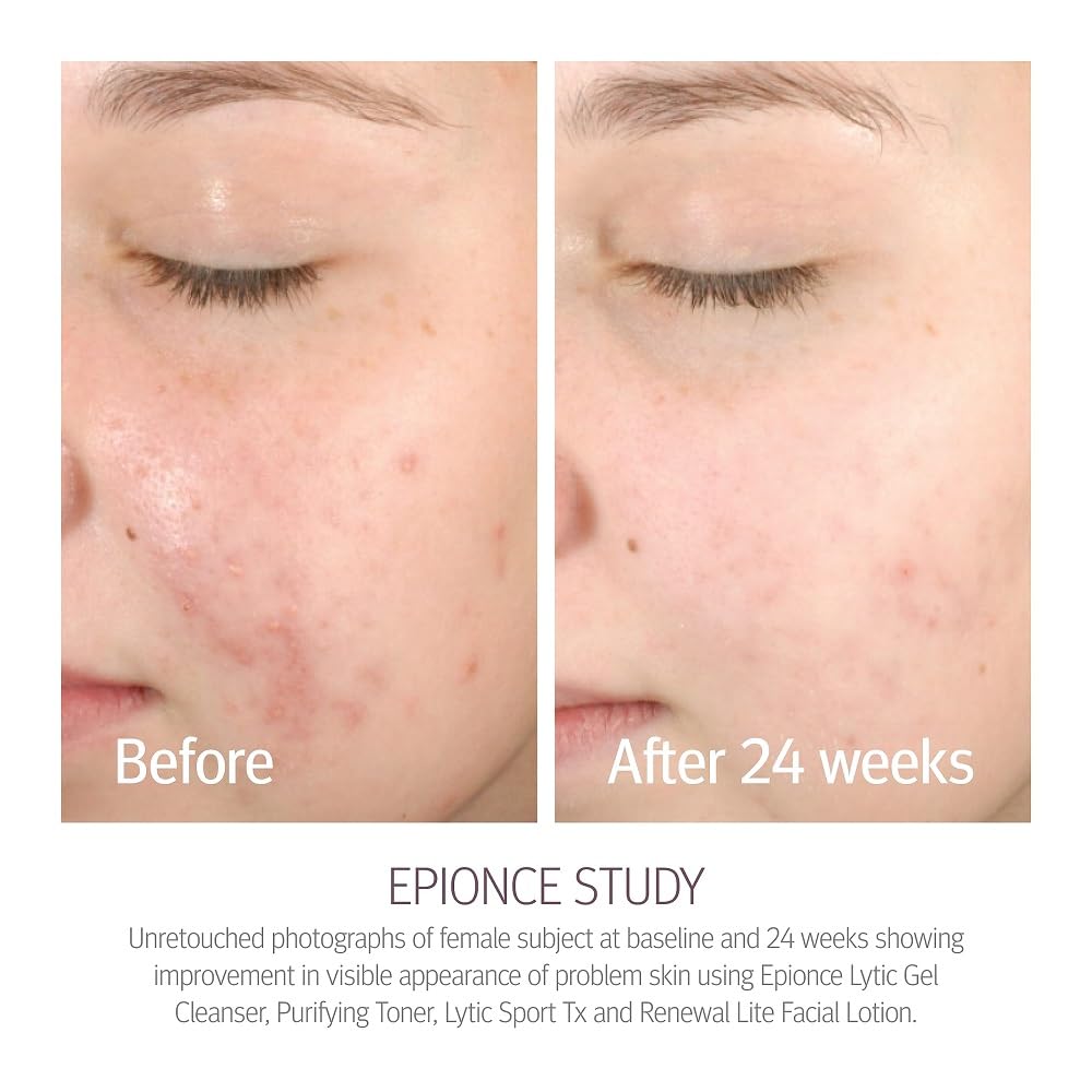 Epionce Renewal Lite application on face demonstrates quick-absorbing hydration.