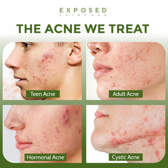 Exposed Skin Care acne cleanser pump-action shows easy daily application.