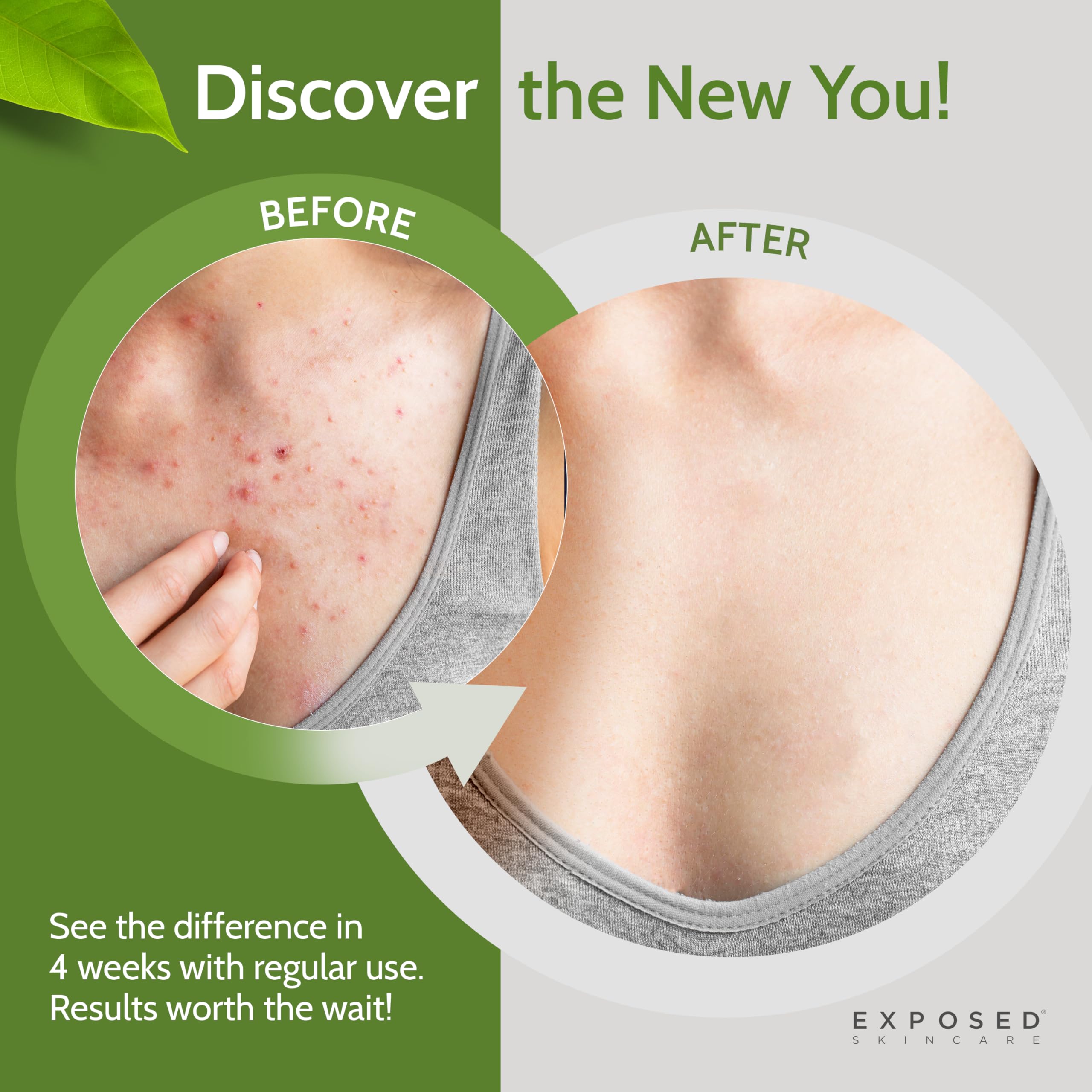 Exposed Skin Care bacne back closeup highlights targeted cleansing for acne-prone areas