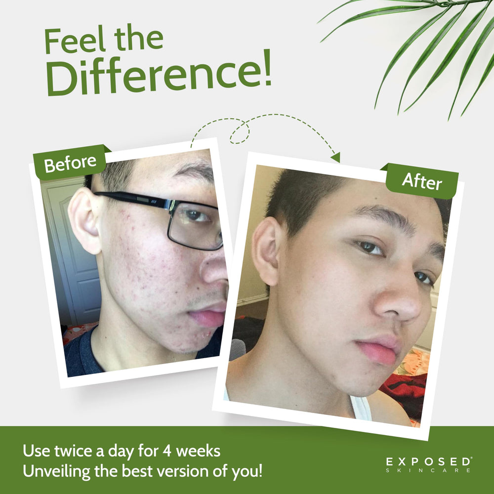 Exposed Skin Care Clear Pore Serum being applied to balance excess oil on skin.