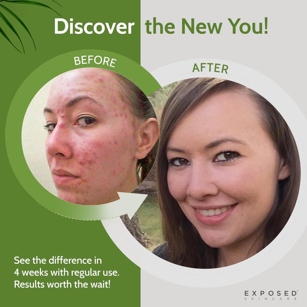 Exposed Skin Care witch hazel toner ingredients highlight calming properties.