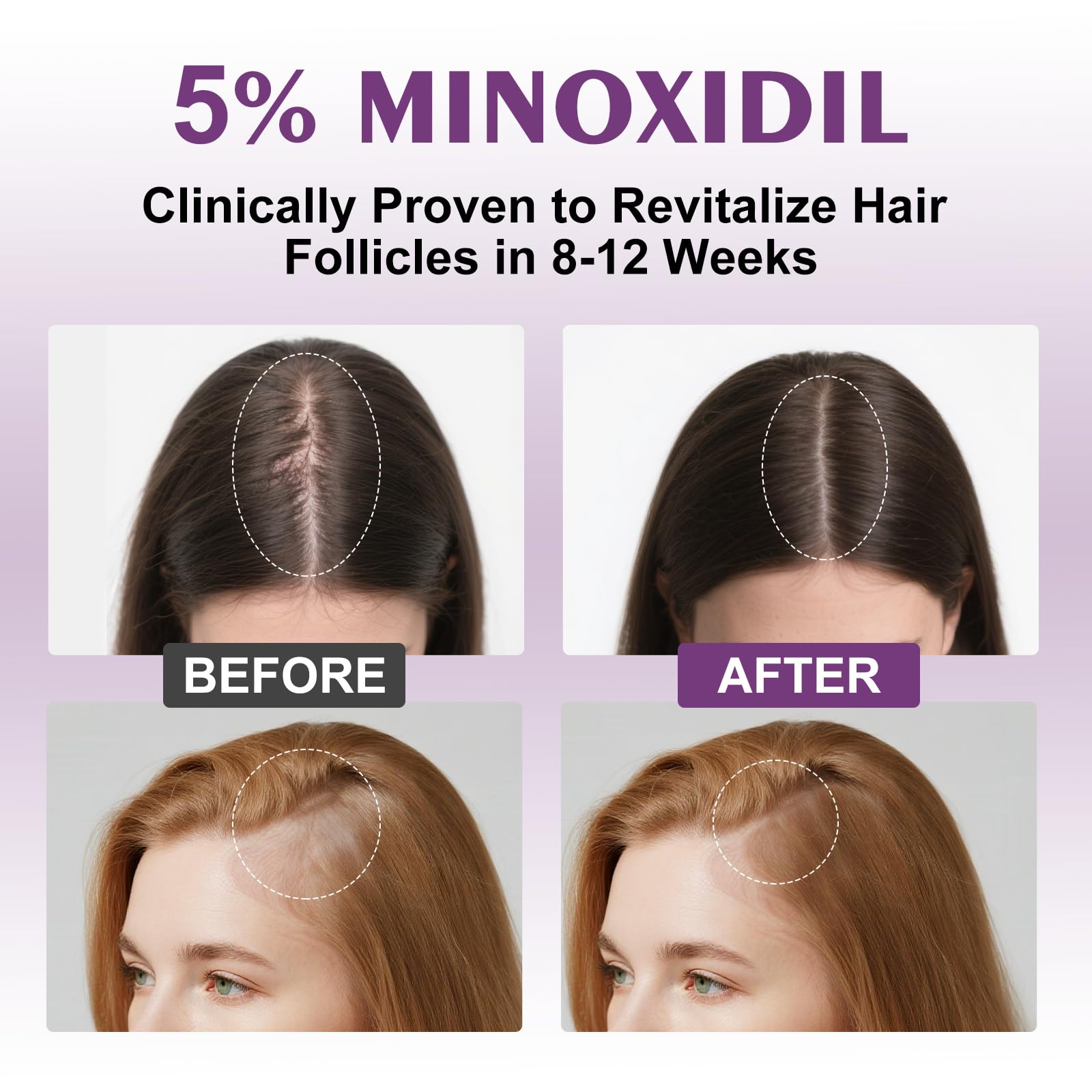 EZBIORT minoxidil 5% women spray bottle with biotin for easy application
