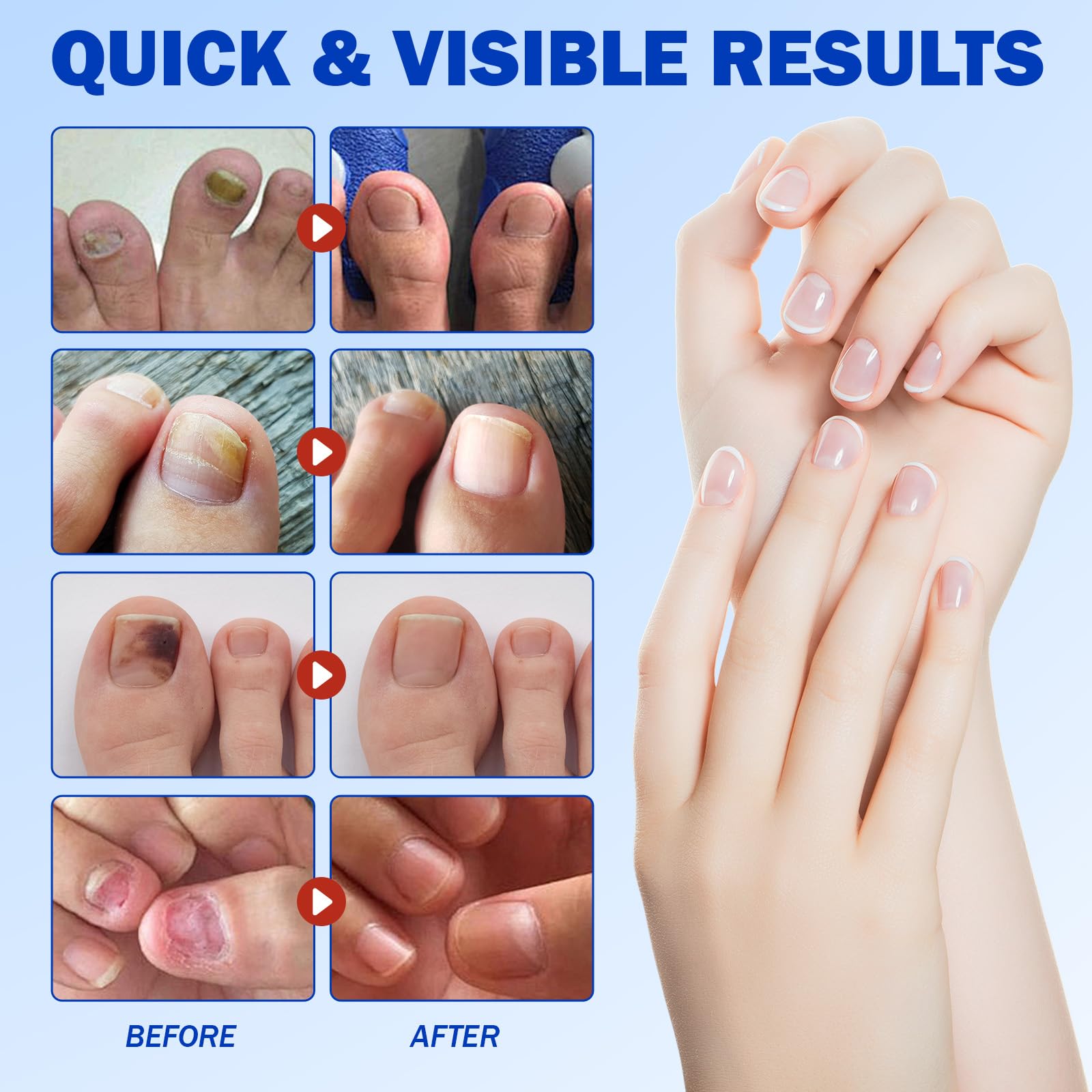 Fanshi Nail Patches adhered securely via hydrogel technology for overnight wear