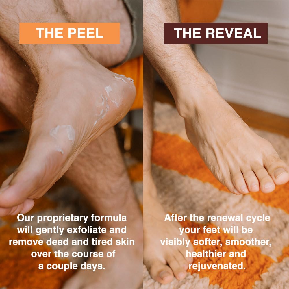 FEETS peeled dead skin on sole shows the renewal process over days.