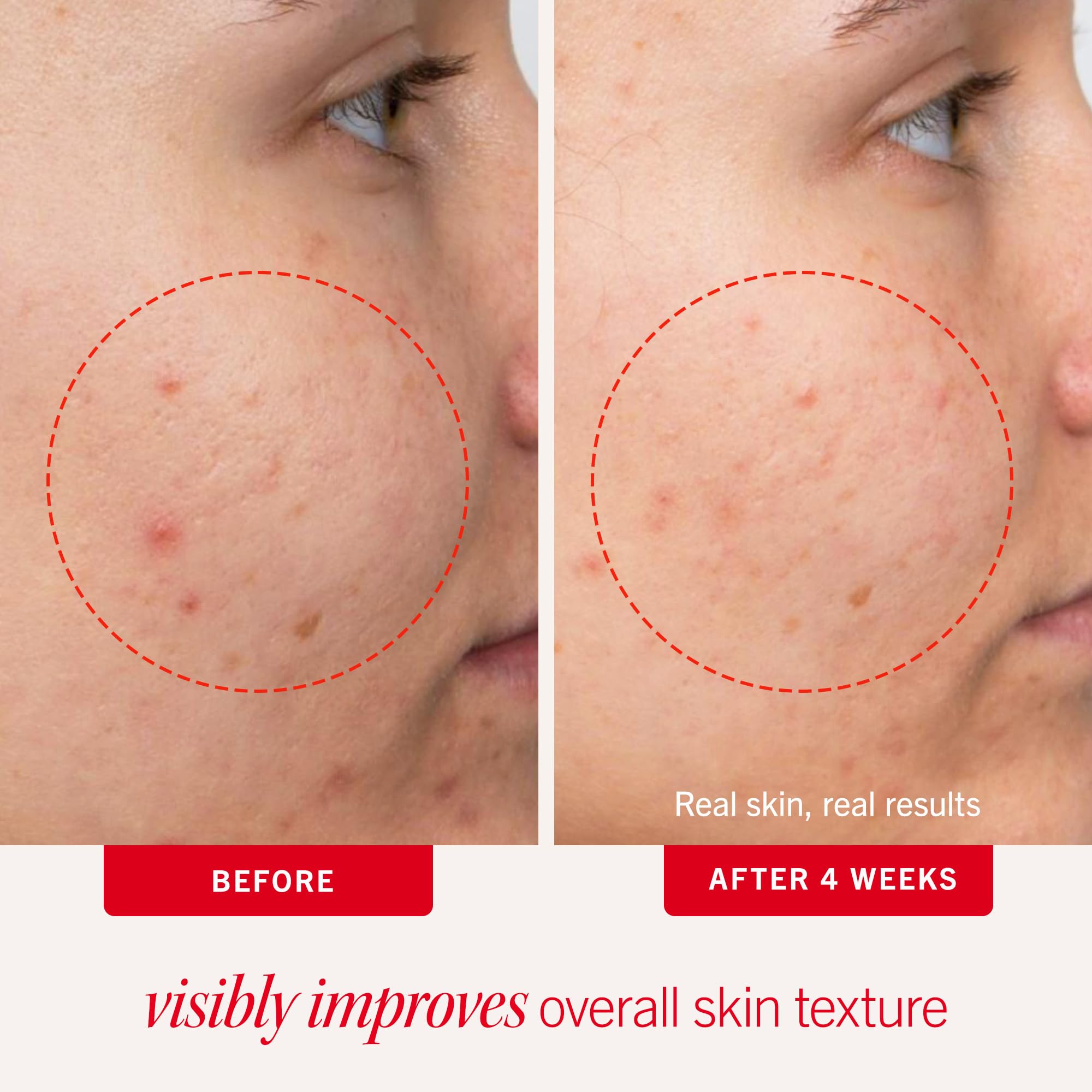First Aid Beauty acne pads face swab application for easy daily use on acne-prone skin
