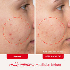 First Aid Beauty acne pads face swab application for easy daily use on acne-prone skin