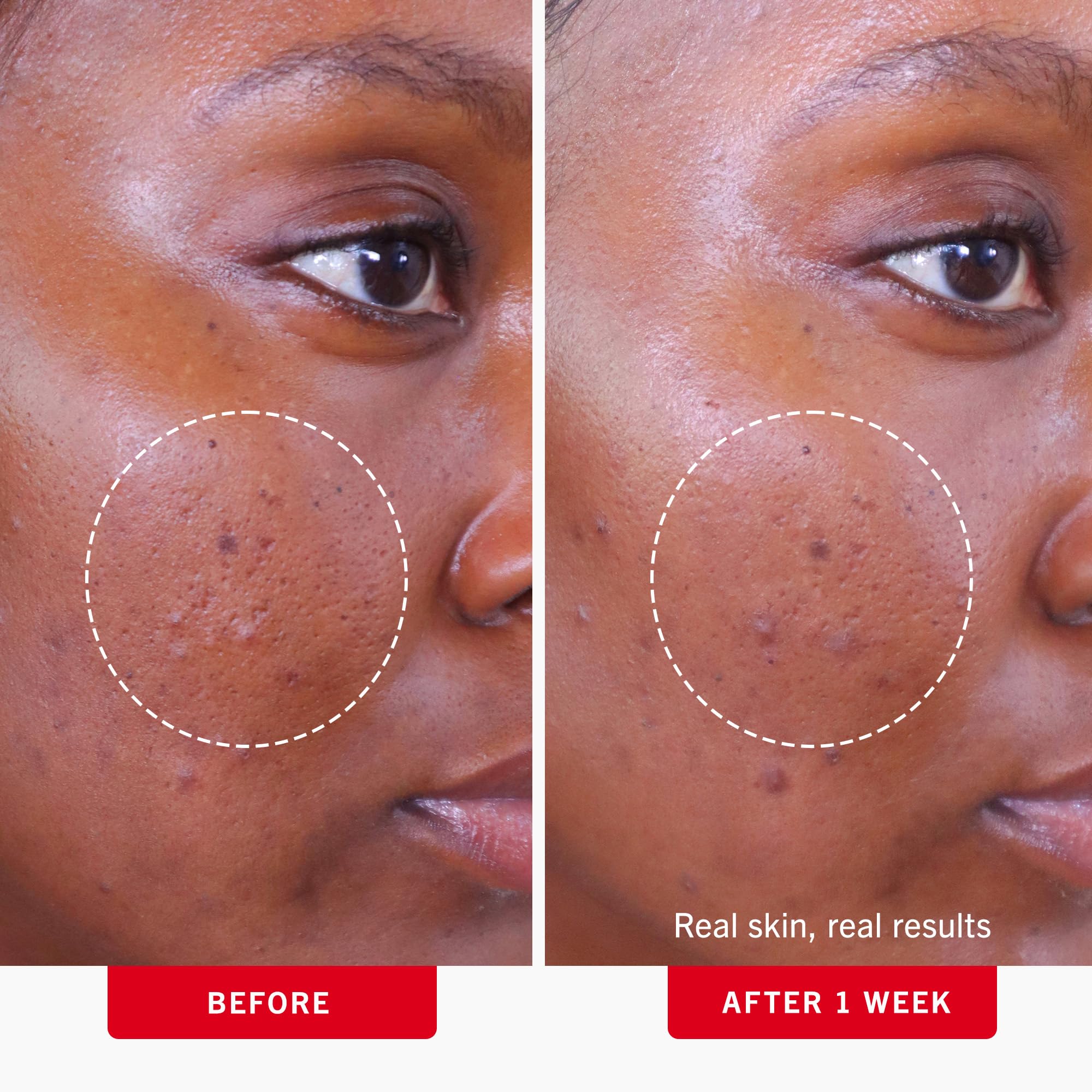 First Aid Beauty acne pads no-alcohol formulation gentle on sensitive skin