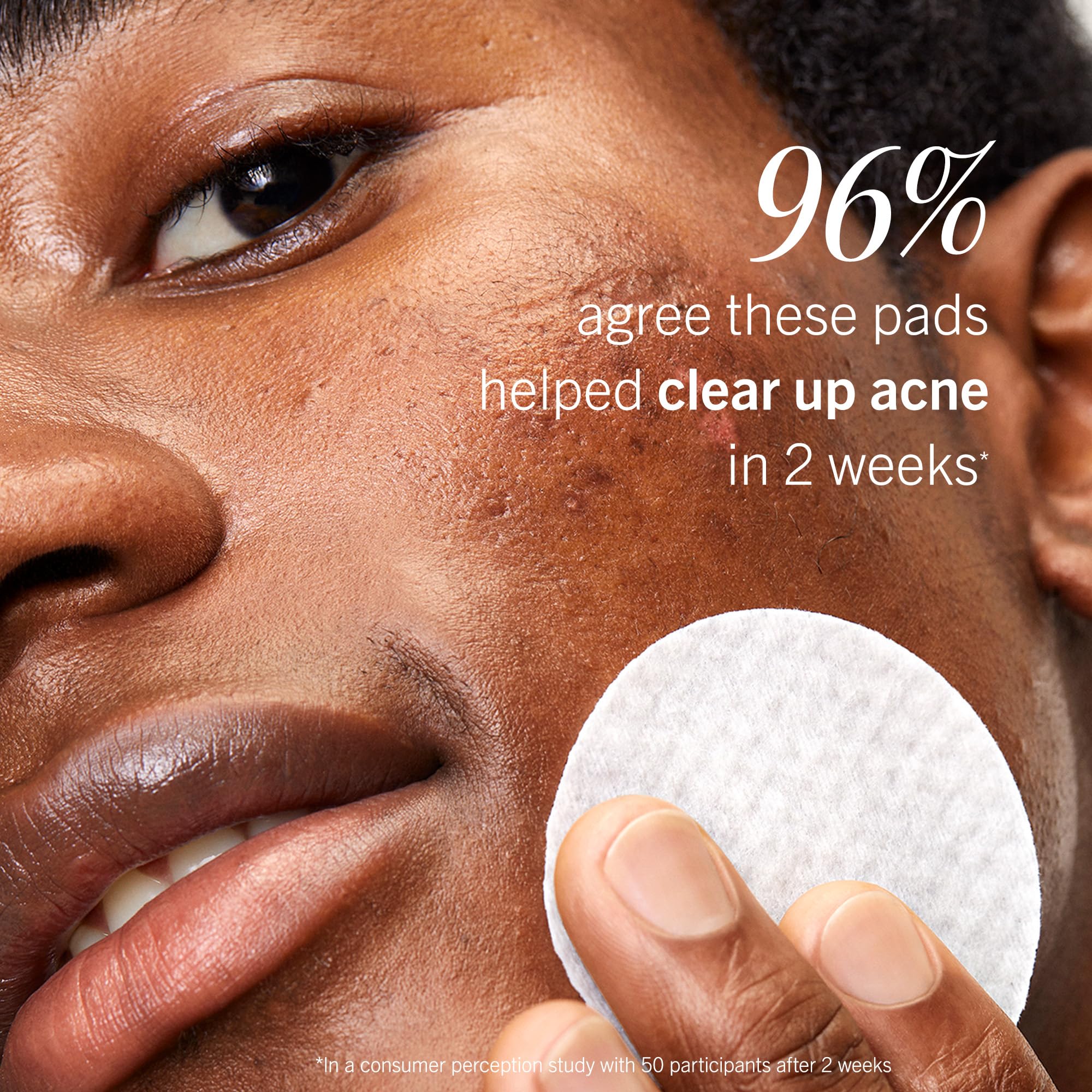 First Aid Beauty acne pads two-week results concept highlighting perceived clarity