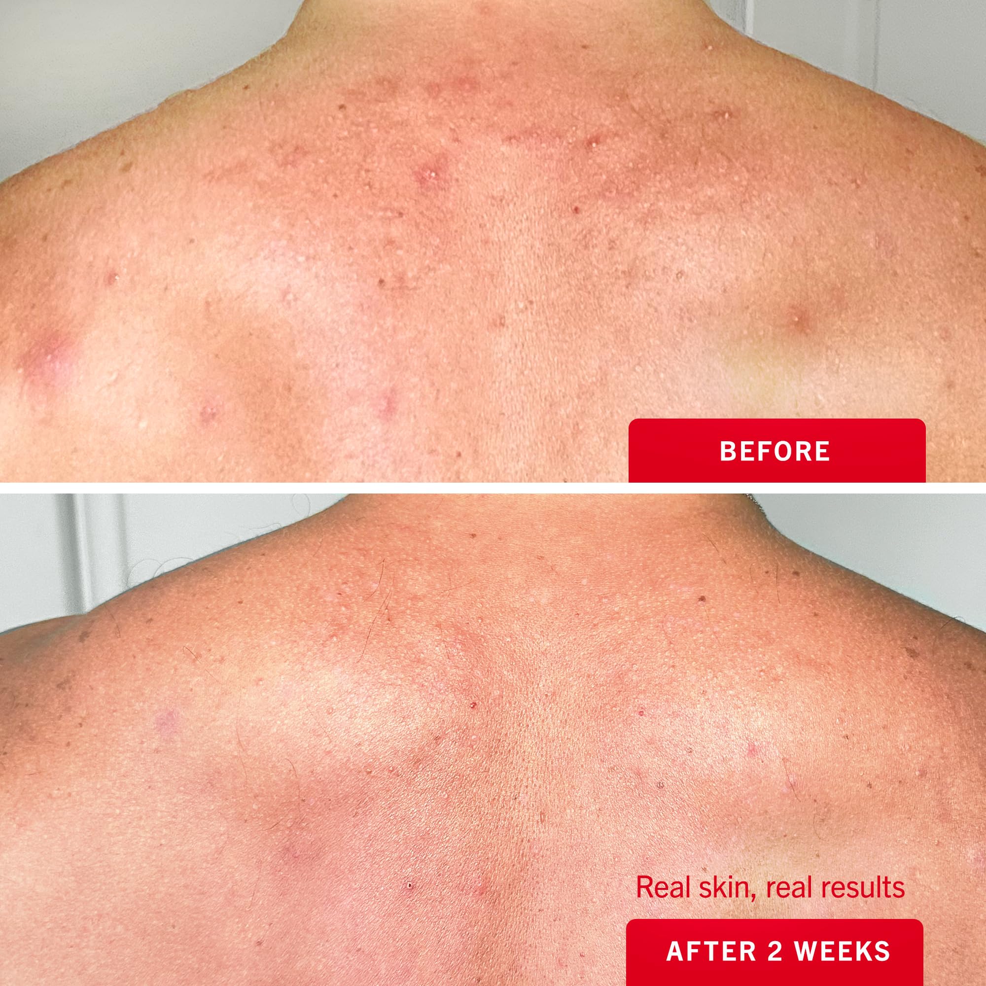 First Aid Beauty Body Acne Spray butt-area coverage reaches hard-to-reach zones.
