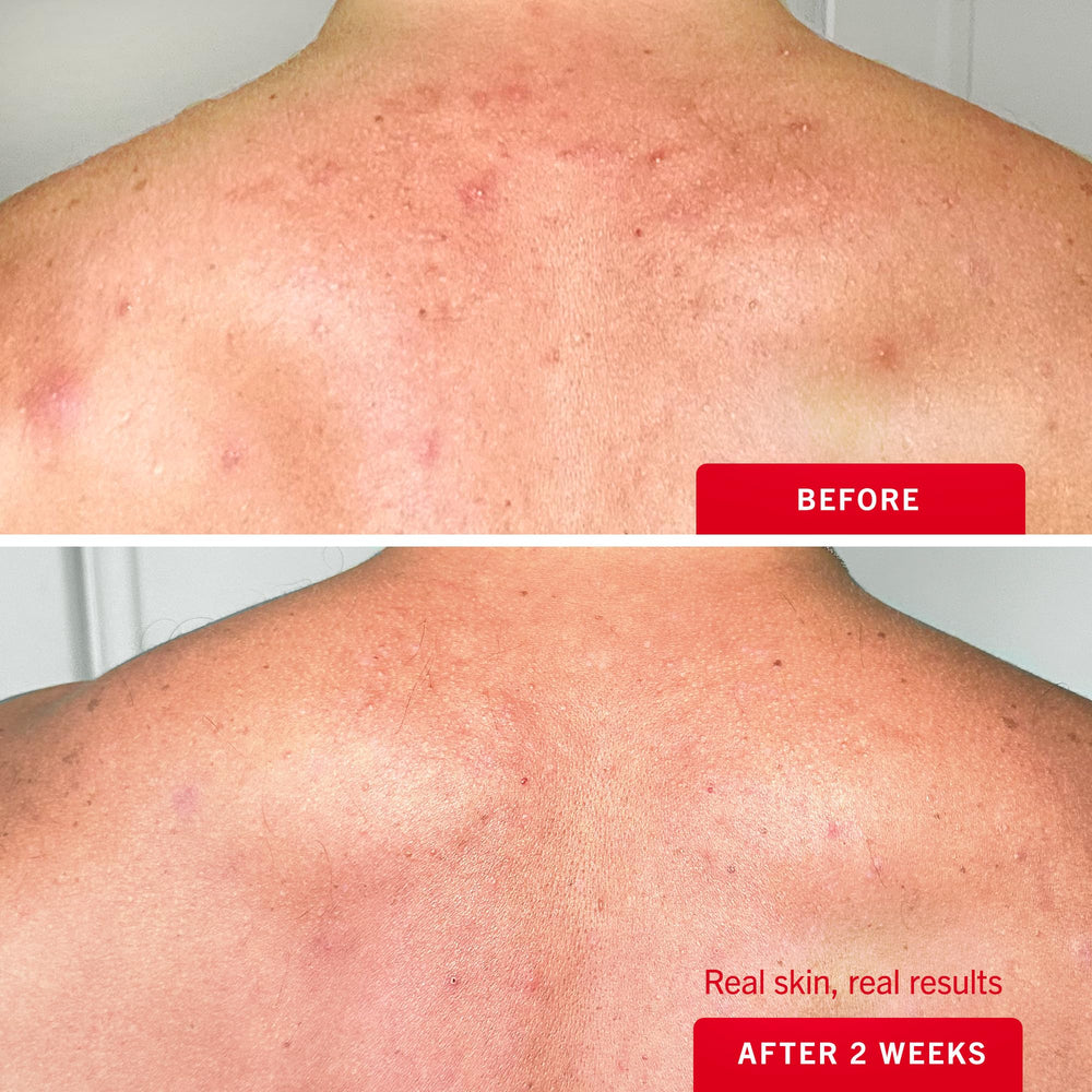 First Aid Beauty Body Acne Spray butt-area coverage reaches hard-to-reach zones.