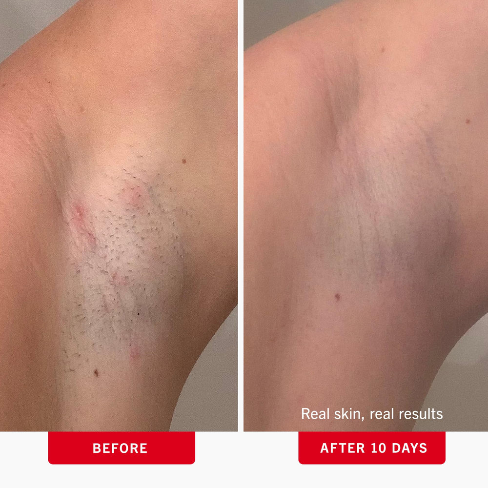 First Aid Beauty pads on bikini area for reduced irritation and fewer ingrown hairs.