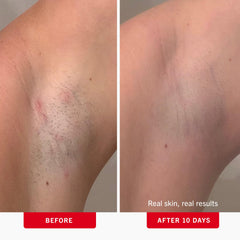 First Aid Beauty pads on bikini area for reduced irritation and fewer ingrown hairs.