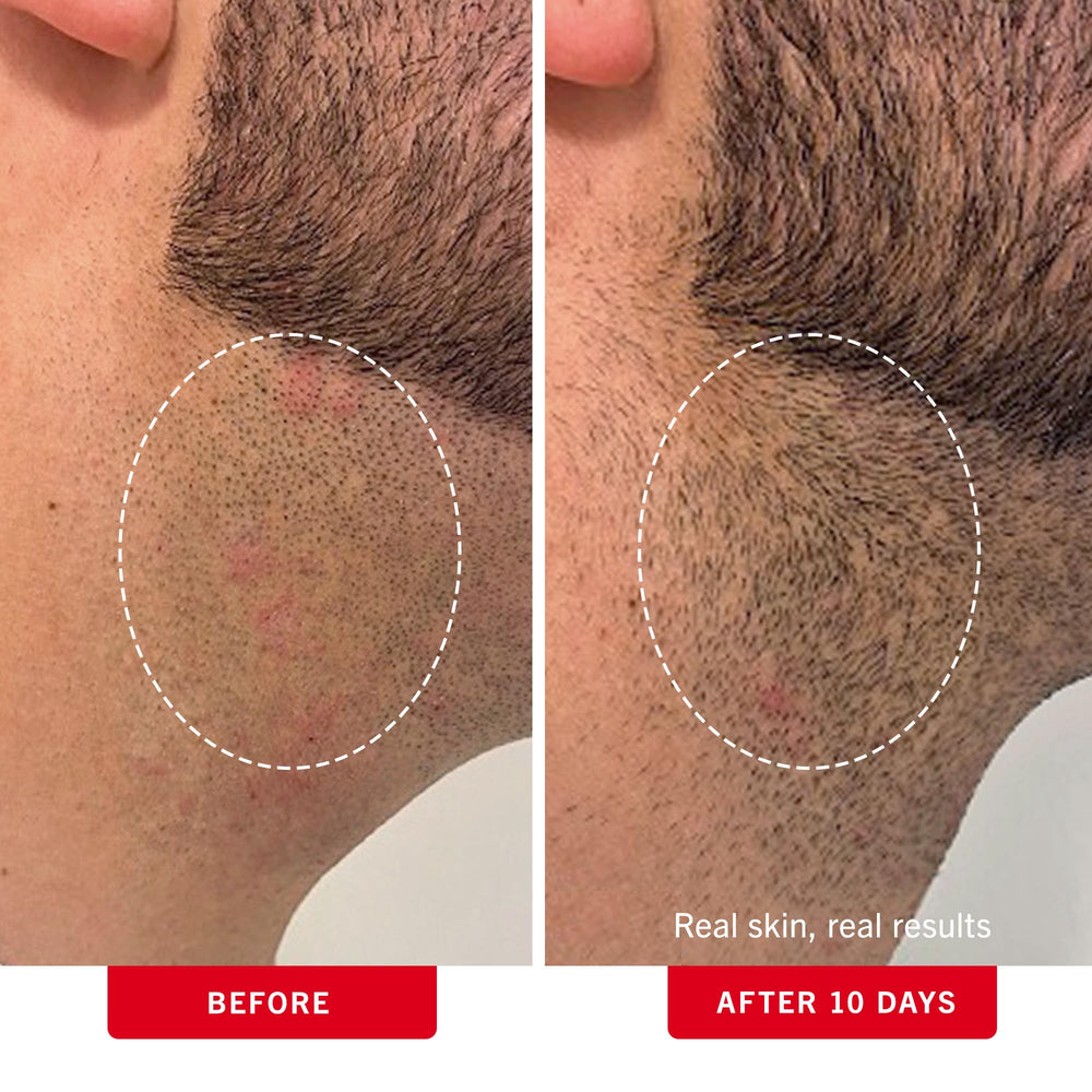 First Aid Beauty close-up showing glycolic and salicylic acids for gentle exfoliation.