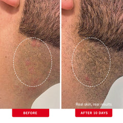 First Aid Beauty close-up showing glycolic and salicylic acids for gentle exfoliation.