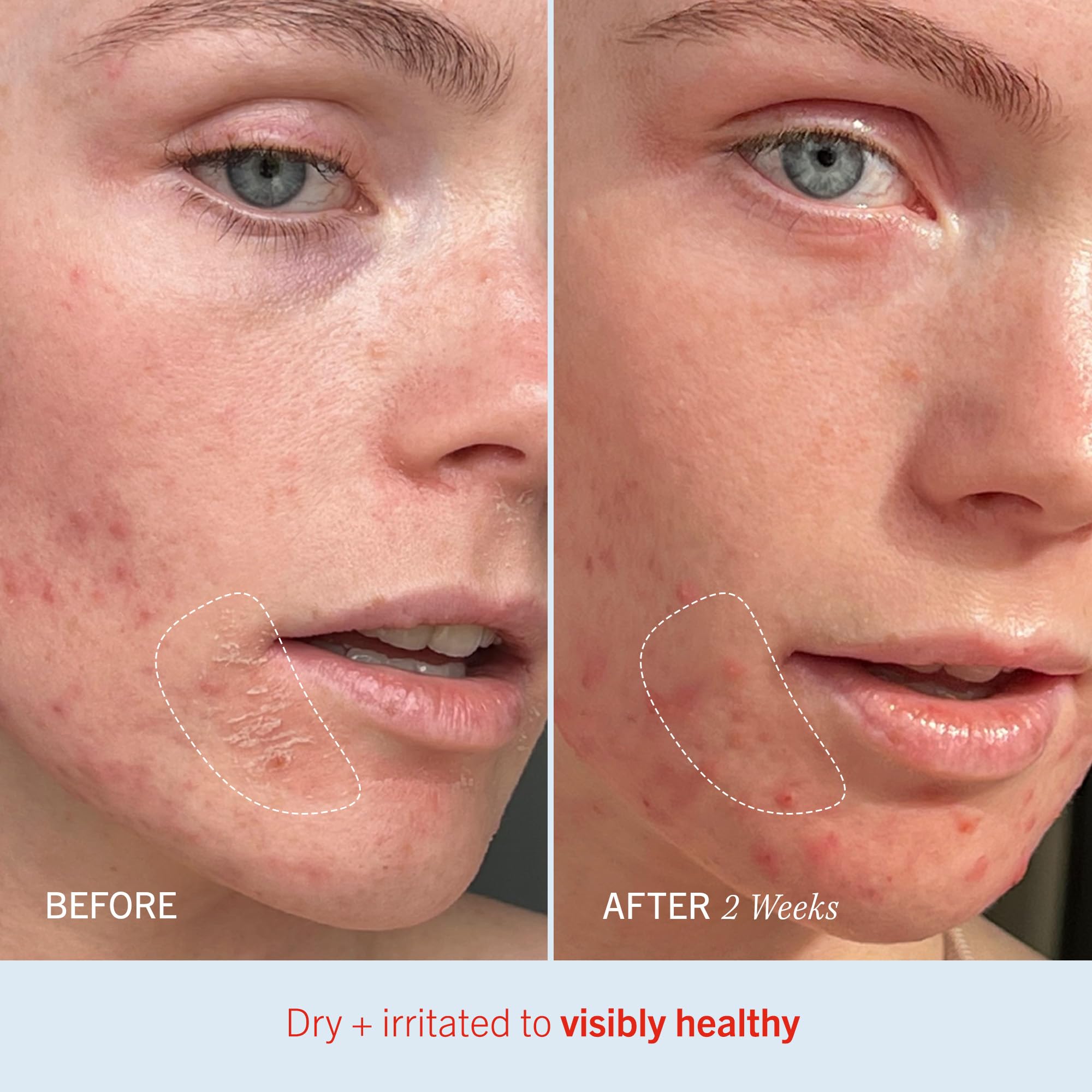 First Aid Beauty Ultra Repair Cream skin-smoothing on dry areas.