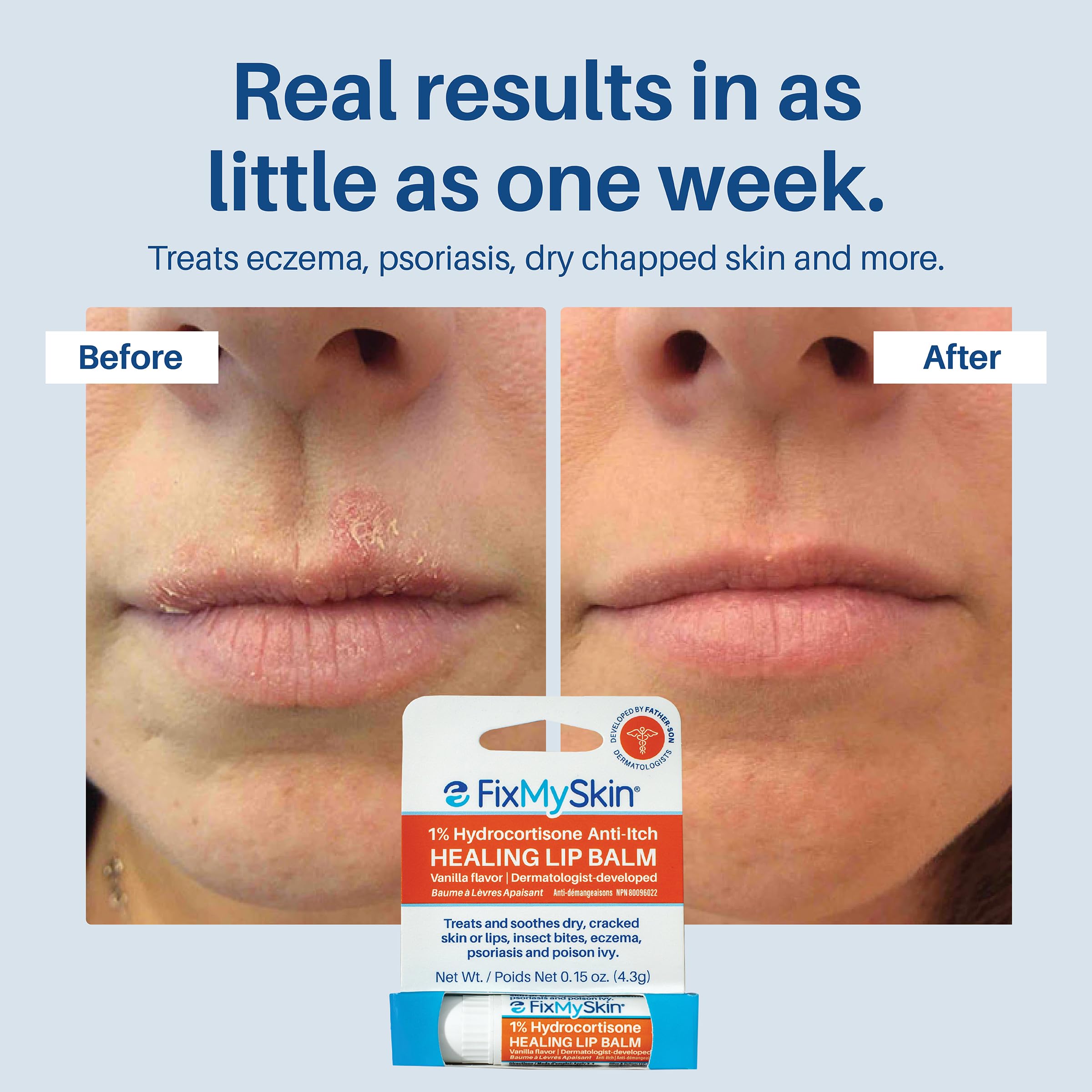 FixMySkin eczema and psoriasis support in lip care reduces inflammation naturally.