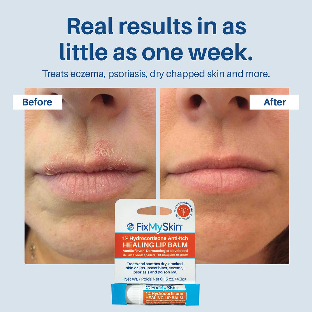 FixMySkin eczema and psoriasis support in lip care reduces inflammation naturally.
