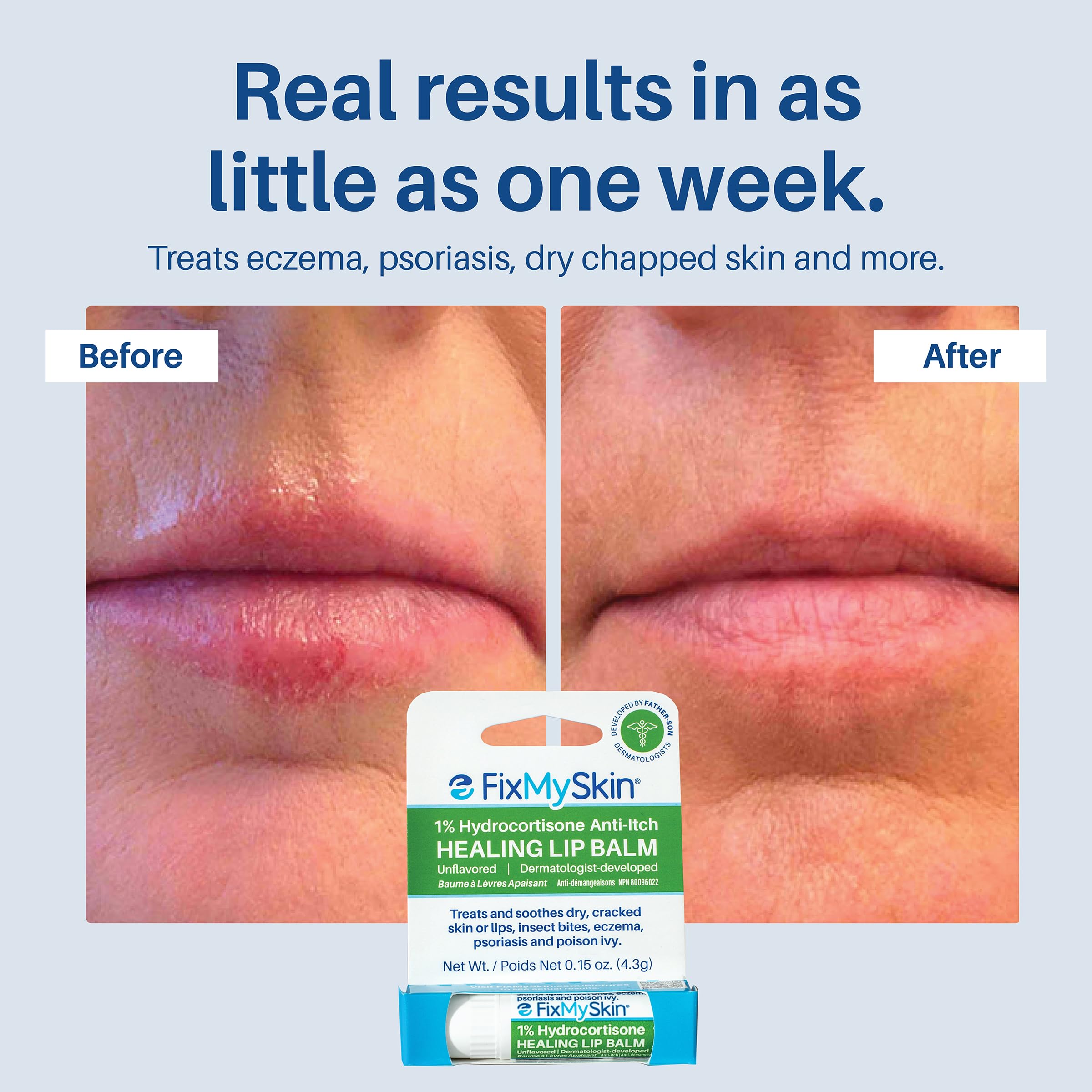 FixMySkin lip balm close-up shows smooth texture for easy application.