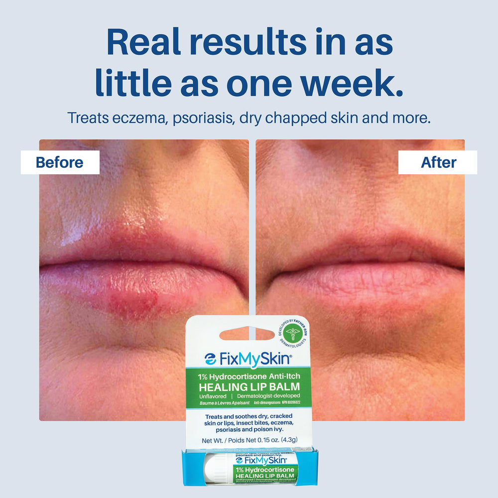FixMySkin lip balm close-up shows smooth texture for easy application.