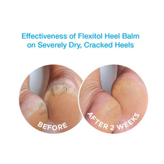 Flexitol Heel Balm being applied to a dry heel for smoother skin, day or night.