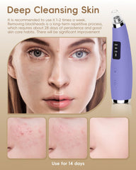 FLYMOOO 5 probes stainless steel for targeted cleansing and skin care