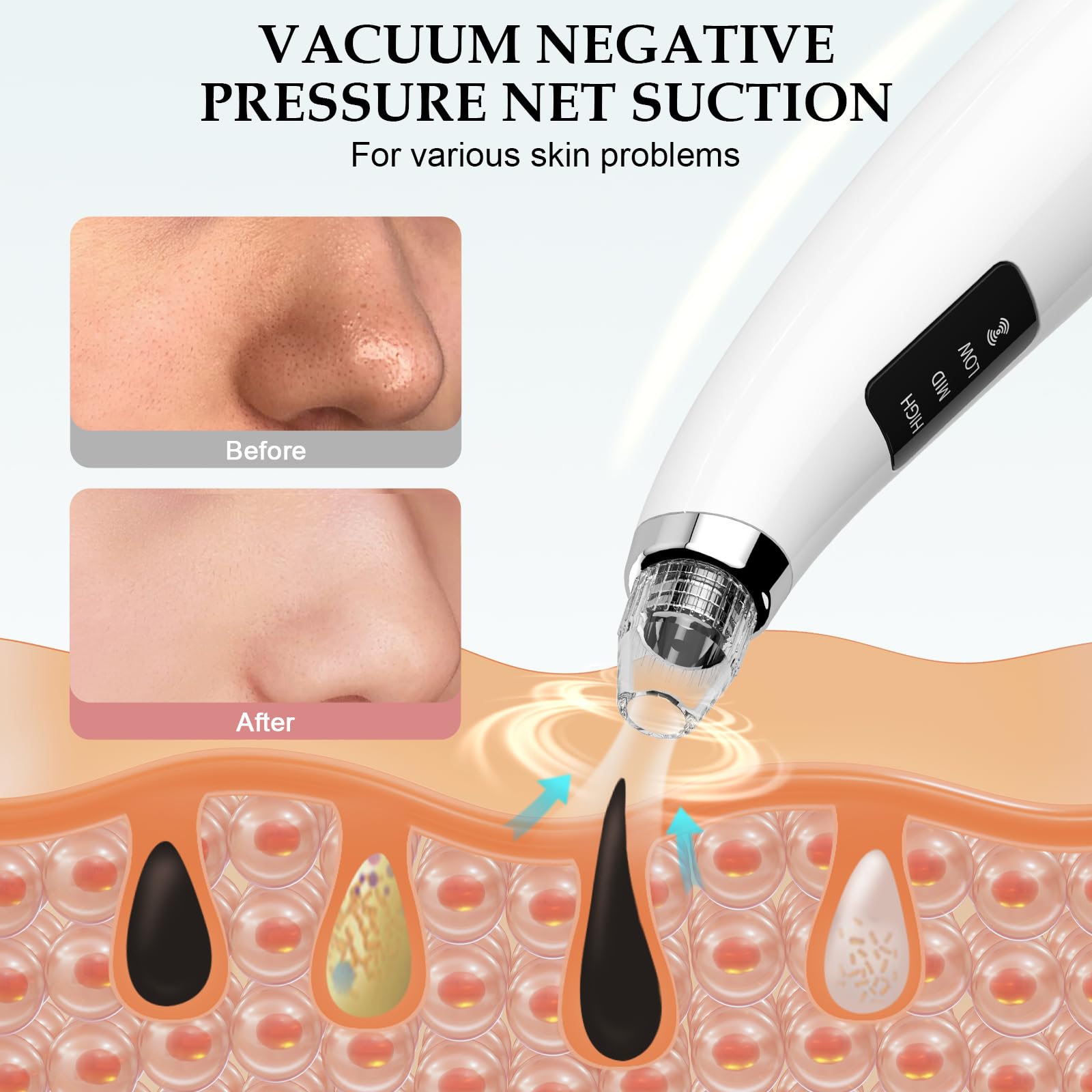 FLYMOOO Facial Pore Vacuum probes-pack with 5 stainless tips for precision
