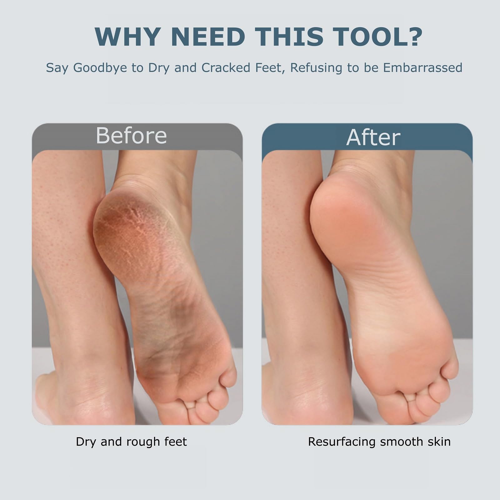 Fooseey foot care use-case showing cracked heels before and after treatment.